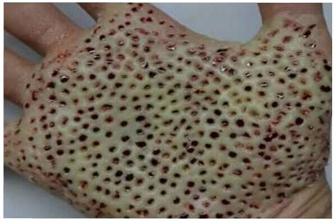 trypophobia feet|what cause holes in skin.